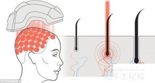 頭盔是前美國航空航天局的科學家Tamim哈米德發明的，他是theradome創始人兼首席執行官。