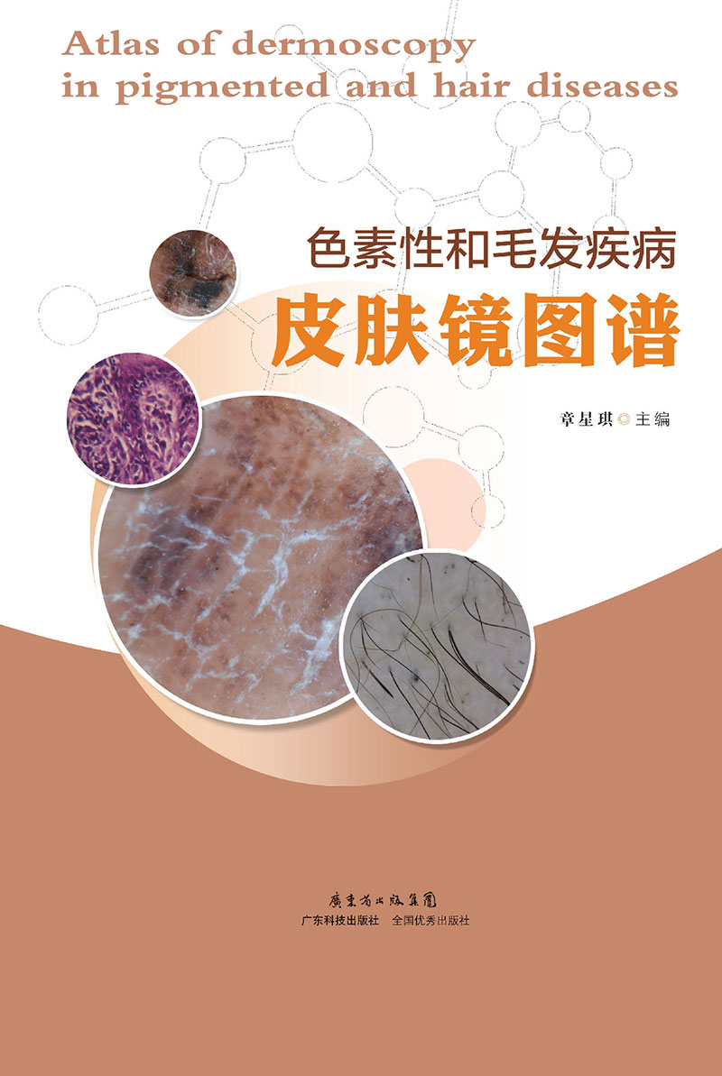 色素性和毛發(fā)疾病皮膚鏡圖譜